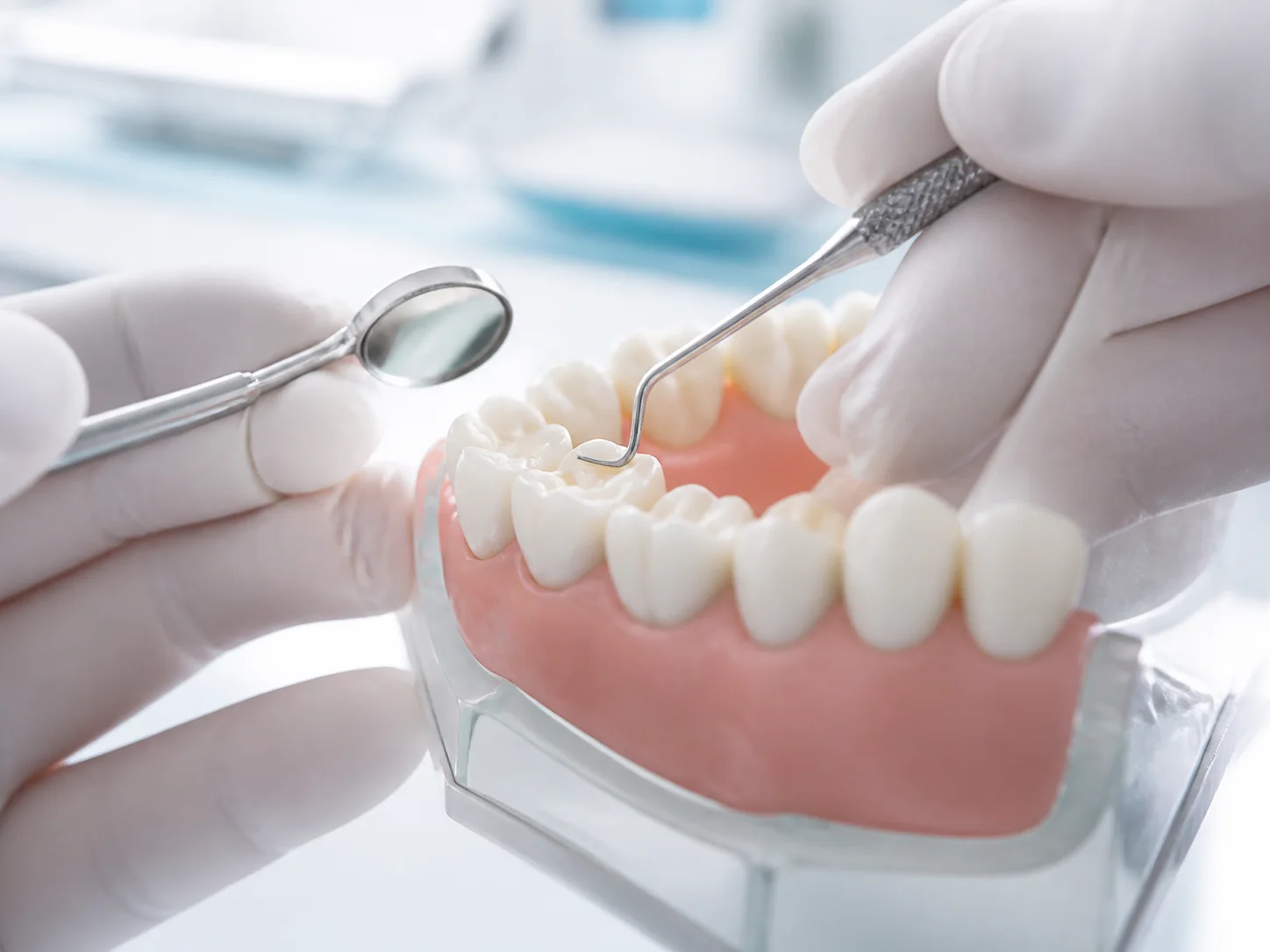 Modelo dental durante una atención restauradora, imagen ilustrativa de curaciones.